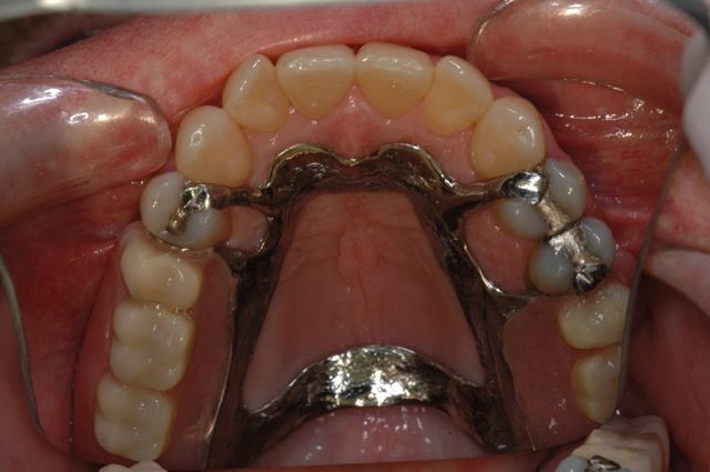 One Tooth Dentures Kansas City MO 64999